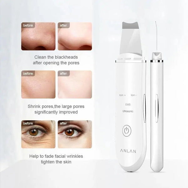 Ultrasonic Skin Scrubber Pen for Deep Facial Cleansing Tool